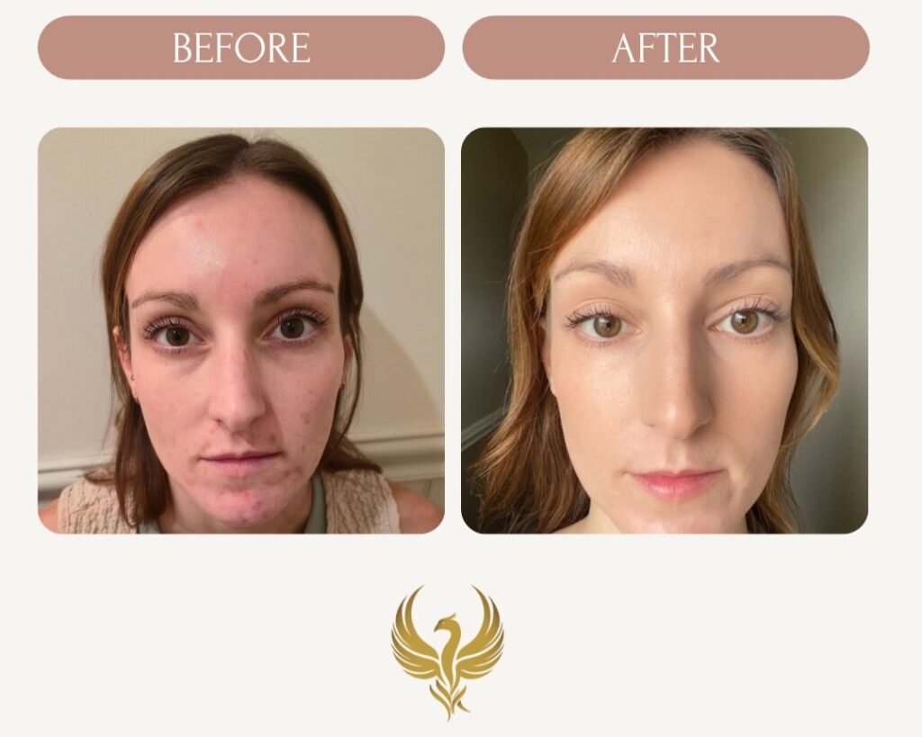 2 Weeks After Treatment