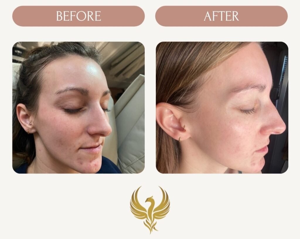 Immediate Results After 1 Microneedling Session