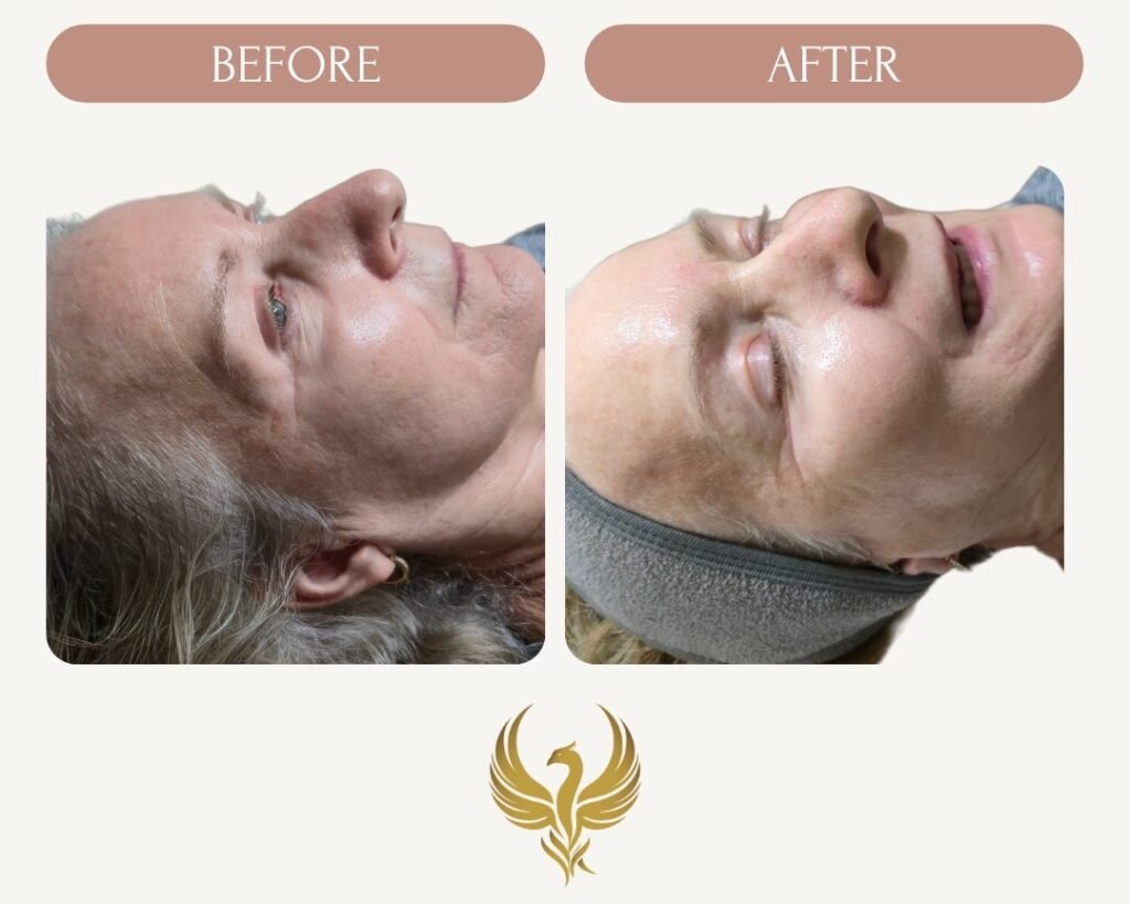 Immediate Results After Microneedling with Hyaluronic Acid & Rejuvinating Serum