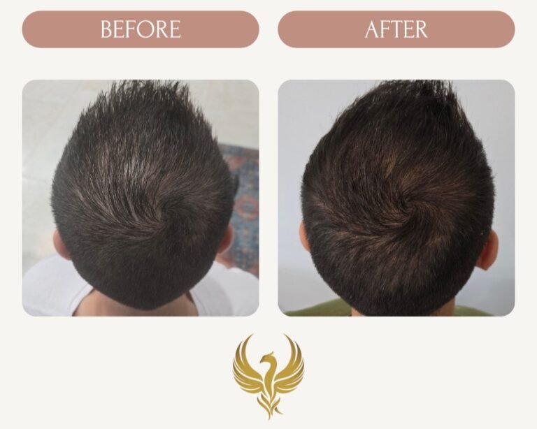 60 days, Results After 2 Treatments