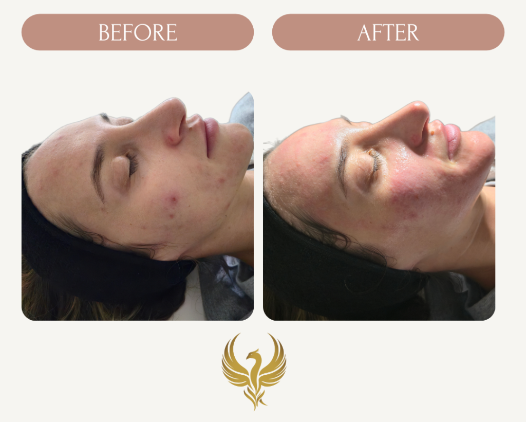Immediate Results After Glycolic Peel & Microneedling