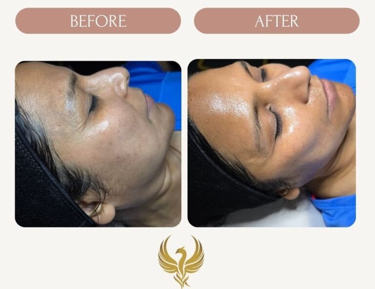 Immediate Results After PRX Peel and Microneedling