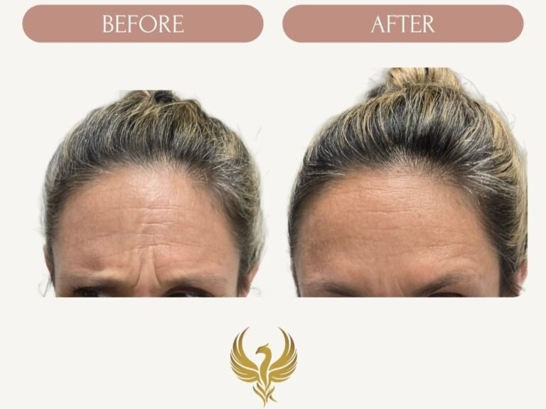 Forehead/ Frown Lines (Frontalis/ Glabella)