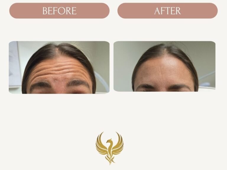 Forehead (Frontalis)