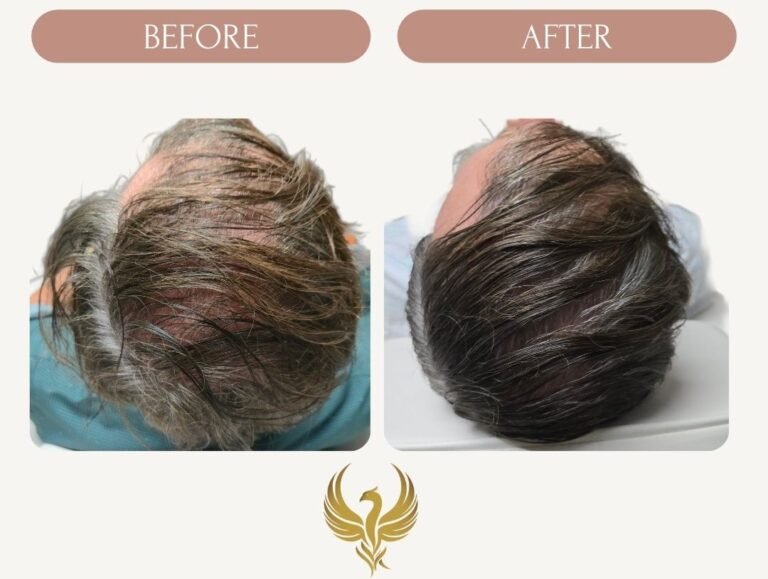 30 Days After 1st PRP Treatment