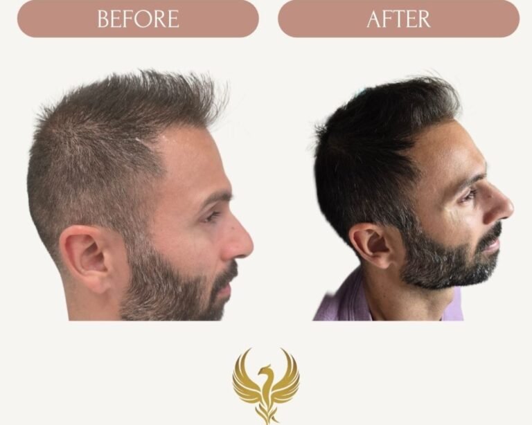 10 months, 6 PRP Treatments