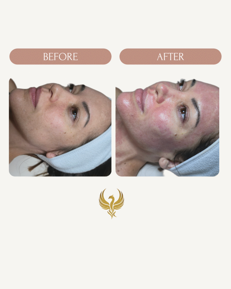 Immediate Results After PRX T-33 Peel & Microneedling