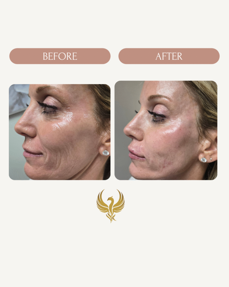 Immediate Results after Plasma Bio-gel Filler, Smile lines, Cheeks, Upper Lip (Smoker's lines), Temple