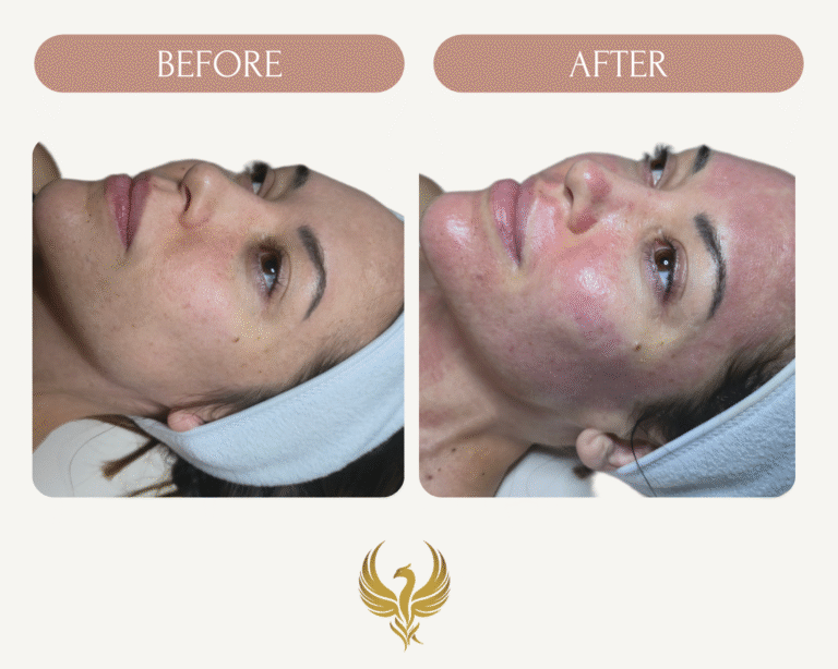 Immediate Results After PRX T-33 Peel & Microneedling