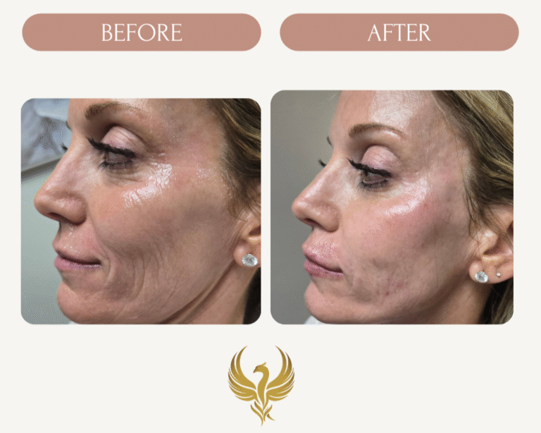 Immediate Results after Plasma Bio-gel Filler, Smile lines, Cheeks, Upper Lip (Smoker's lines), Temple
