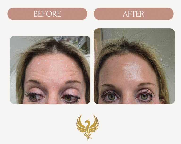 2 weeks after Forehead (Frontalis) Botox