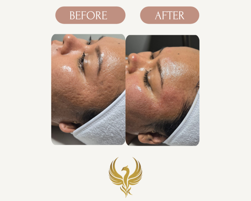Immediate Results Microneedling with PRP for Ice Pick Acne Scars