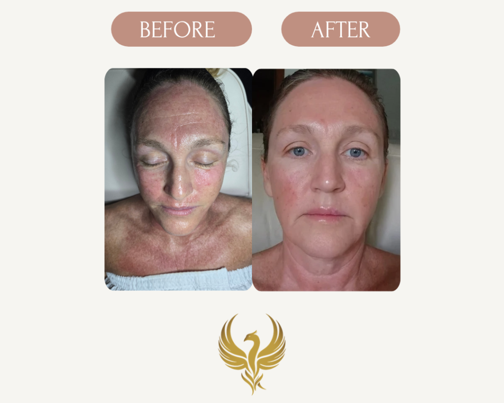 Results 24 hrs After Microneedling with PRP for Fine lines, Scars and Sun Damage