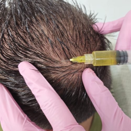 hair restoration