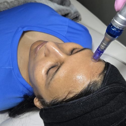 microneedling
