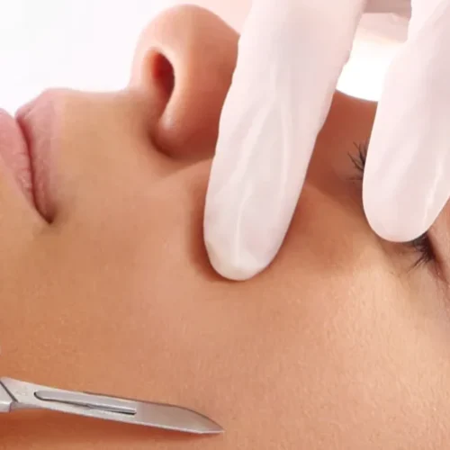 dermaplaning